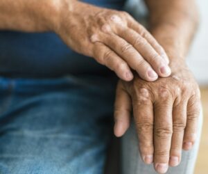 Elderly man suffering from psoriasis on hands